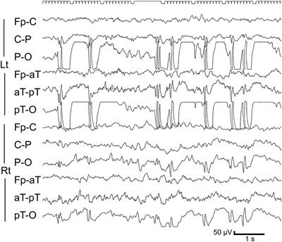 Case Report: Four Cases of Panayiotopoulos Syndrome Evolving to Juvenile Myoclonic Epilepsy